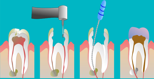 root canal